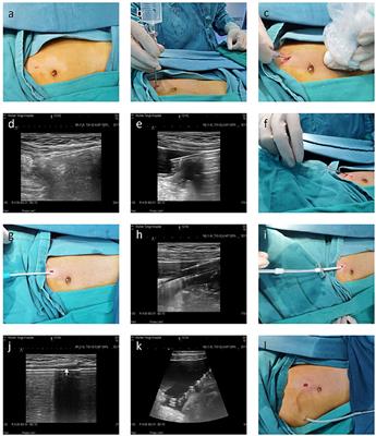 Ultrasound-Guided Modified Seldinger Placement of Tenckhoff Catheters in Pediatric Patients Undergoing Peritoneal Dialysis: Single Center Experience